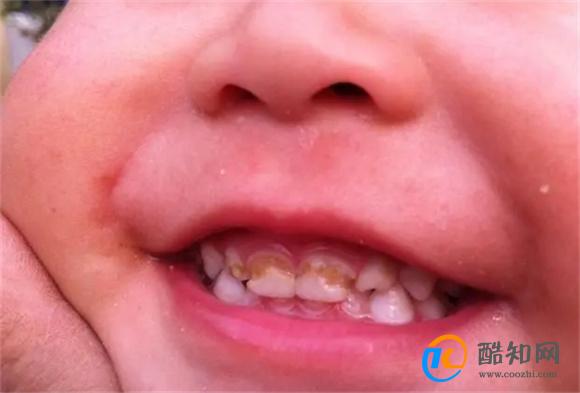 孩子嘴里长了“双排牙”？背后原因有二，多半是父母造成的！